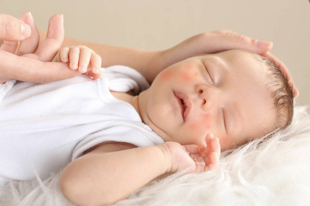 mother hands touching sleeping little child with red rash, closeup. Concept of babies allergies - Foto, Bild