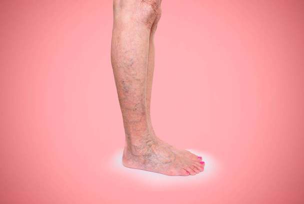 A női lábak visszerek - Fotó, kép