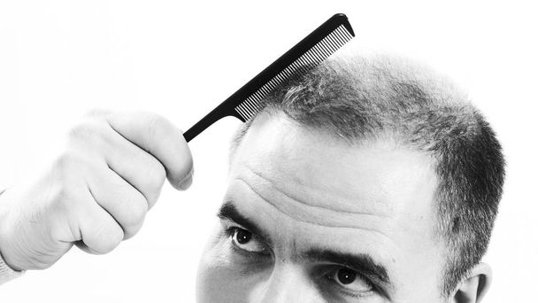 Middle-aged man concerned by hair loss Baldness alopecia close up black and white, white background - Foto, Bild
