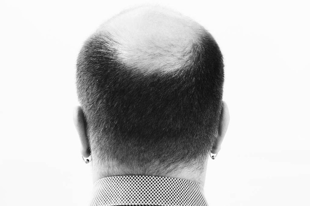 Middle-aged man concerned by hair loss Baldness alopecia close up black and white, white background - Фото, зображення