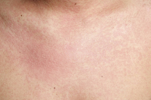 Homme avec dermatite problème d'éruption cutanée, éruption allergique
 - Photo, image