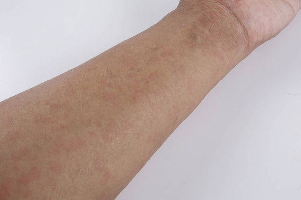 Férfi dermatitis problémáját kiütés, allergiás kiütés - Fotó, kép