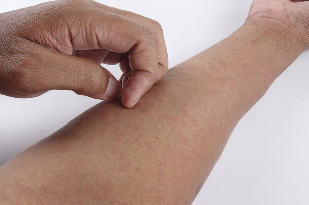 Ihminen, jolla on ihottuma, allerginen ihottuma
 - Valokuva, kuva