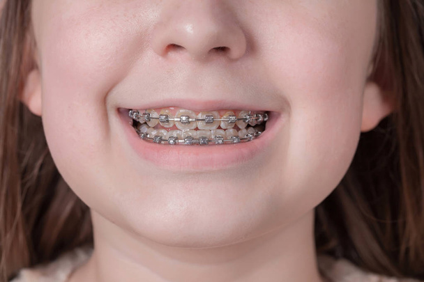 Broad smile girl with metal braces. - 写真・画像