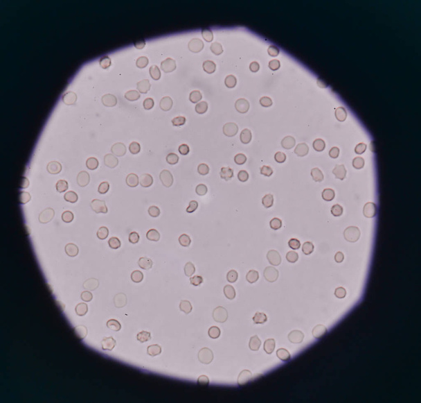 globules rouges frais dans l'échantillon d'urine
. - Photo, image