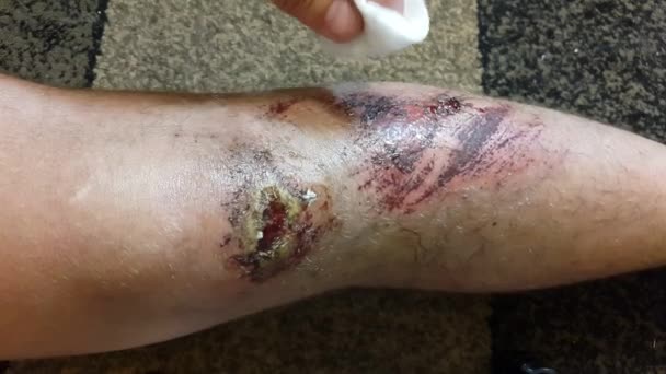 Uma ferida na perna de um homem. Primeiros auxílios
 - Filmagem, Vídeo