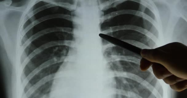 4k doctors study ribs,Rib-cage joints X-ray film for analysis.medical health ho - Footage, Video