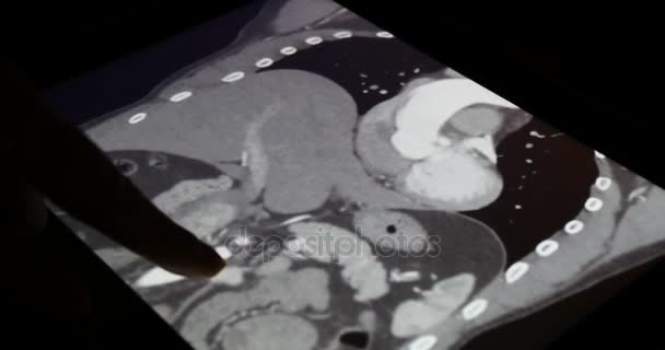 4 k lekarz touch Pet-Ct X-ray film na ekran dotykowy ipad aplikacji oprogramowania do analizy - Materiał filmowy, wideo