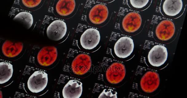 4 k lékaři studují hlava lebka, pet-ct vyšetření mozku X-ray film pro analýzu nemoc. - Záběry, video