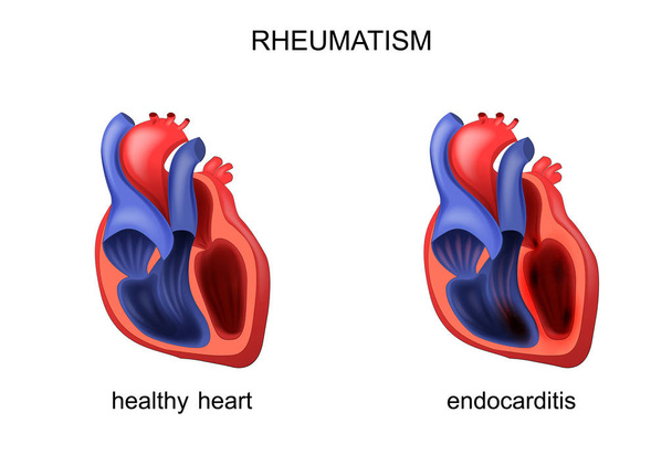 kalp sağlıklı ve hastalıklı endokardit - Vektör, Görsel