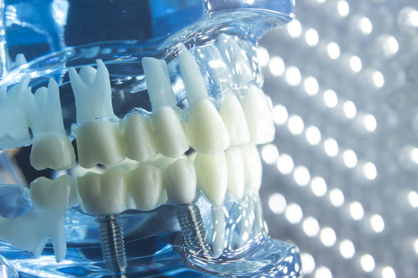 Dentisti impianto dentale dei denti
 - Foto, immagini