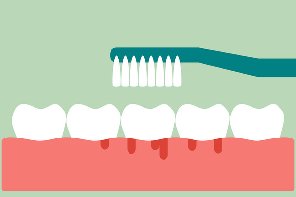 brushing teeth with bleeding on gum and tooth concept gingivitis or scurvy - Vector, Image