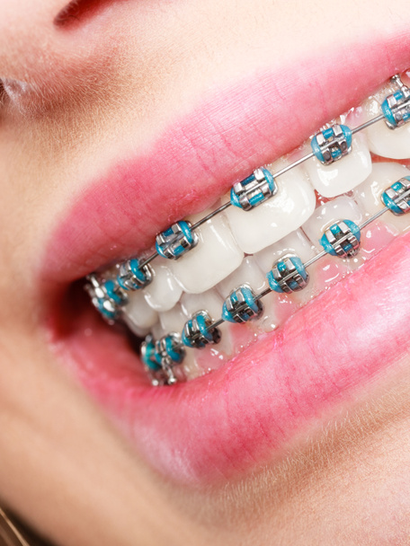 Woman showing her teeth with braces - Fotó, kép