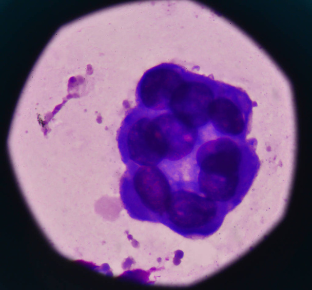 Аномальні злоякісні клітини приклад плевральної рідини
. - Фото, зображення