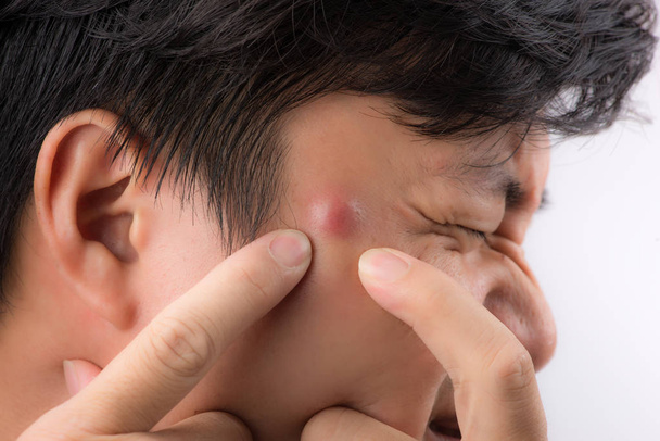man squeezing his pimple - Photo, image