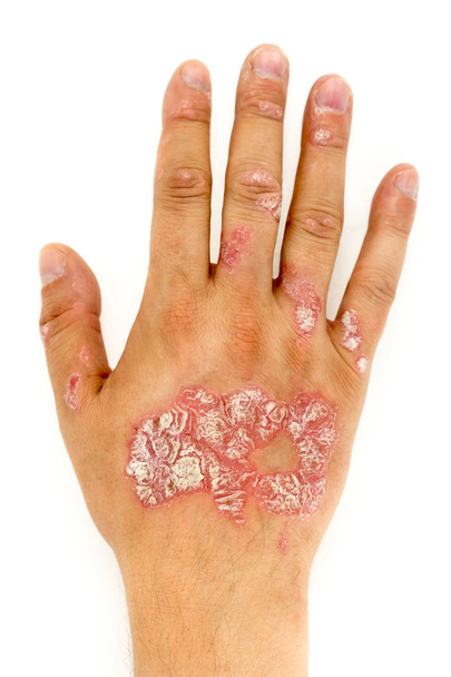 Psoriasi vulgaris sulla mano dell'uomo e unghie delle dita
 - Foto, immagini