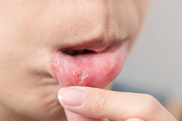 Женский рот страдает от афты
 - Фото, изображение