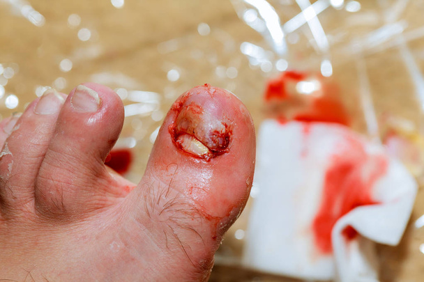 Moretón en la uña del pie derecho hombre desgarrado sangre en la pierna
 - Foto, Imagen