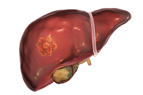 Ilustração do cancro do fígado
 - Foto, Imagem