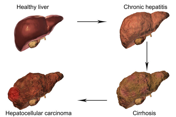 B 型肝炎および C のウイルス感染における肝臓病の進行 - 写真・画像
