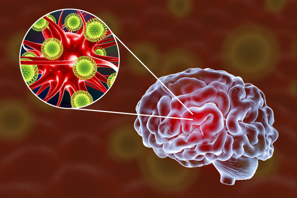 Иллюстрация вирусного энцефалита
 - Фото, изображение