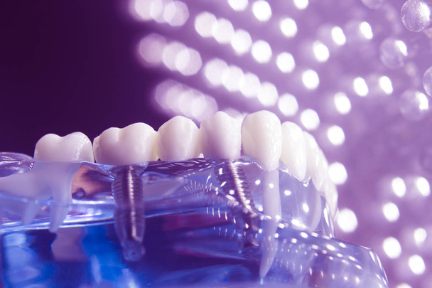 Стоматологи имплантируют зубные зубы
 - Фото, изображение