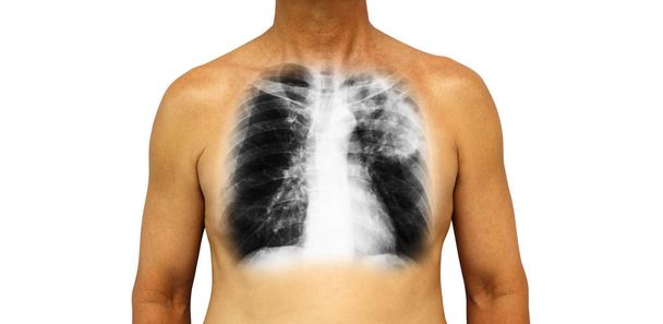 Πνευμονική φυματίωση. Ανθρώπινο στήθος με ακτινογραφία εμφάνιση αποσπασματική διεισδύσει αριστερό άνω πνεύμονα οφείλεται σε λοίμωξη. Απομονωμένη φόντο - Φωτογραφία, εικόνα