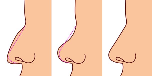 Пастеральна хірургія виконується на носі. До і після
 - Вектор, зображення