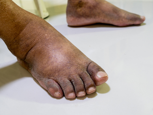 The feet of people with diabetes, dull and swollen.  - Photo, Image