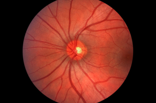 Retina humana - Nervo óptico
 - Foto, Imagem