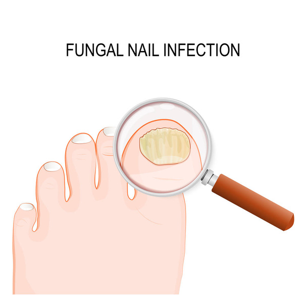 fungal nail infection - Vector, Image