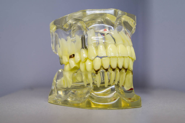 Dental implants and teeth in the skull - Foto, Bild