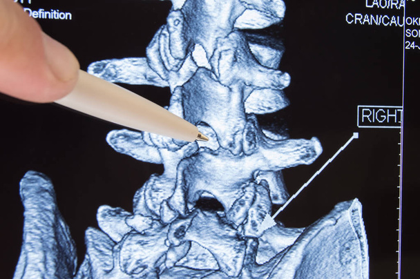 Arzt zeigt auf ct mri scannt Ort in der Wirbelsäule zwischen den Wirbeln, das Verfahren der epiduralen Anästhesie oder Wirbelsäulenpunktion Durchführung ist. Epiduralanästhesie während der Geburt oder neurochirurgischen Operationen  - Foto, Bild