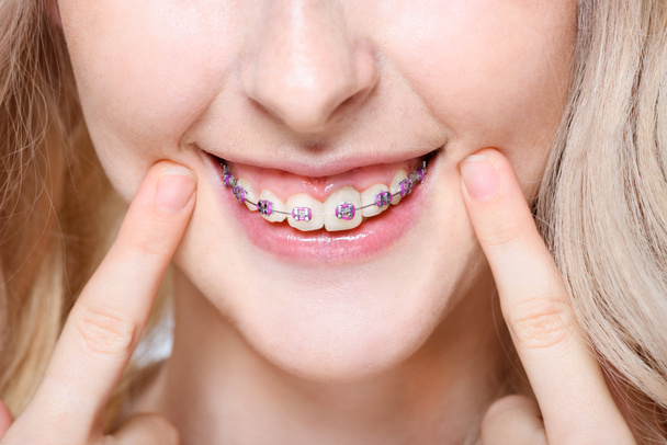 Mujer señalando a los dientes con aparatos ortopédicos
 - Foto, Imagen