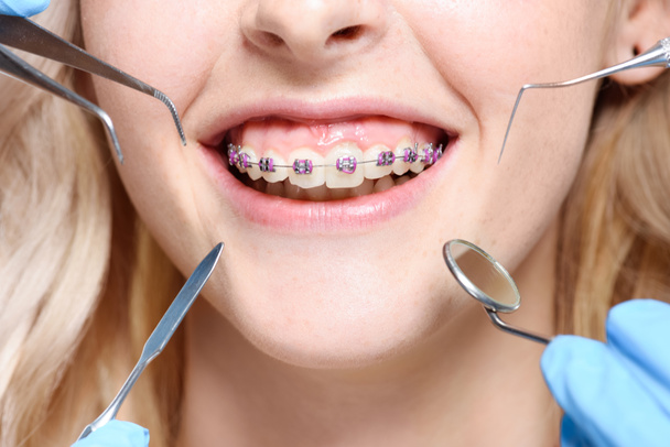  Dentist tools in front of mouth with braces - Photo, Image