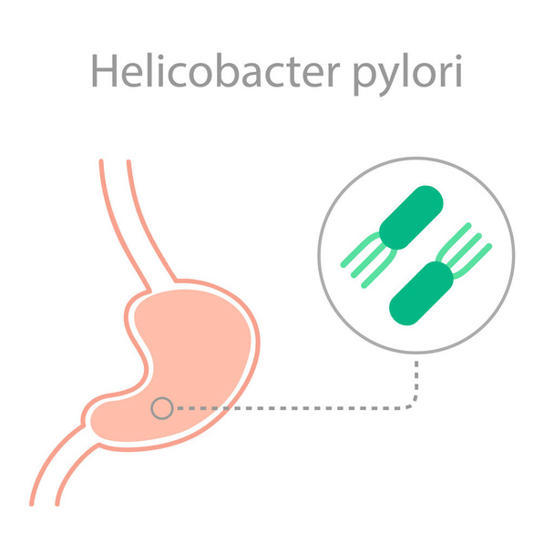 helicobacter pylori bakteerin tauti
 - Vektori, kuva