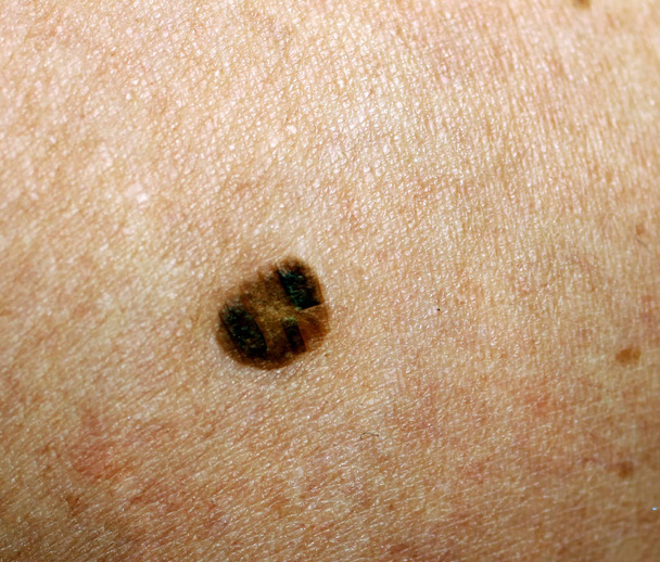Brown spot on the skin. Birthmark on the body - Photo, Image