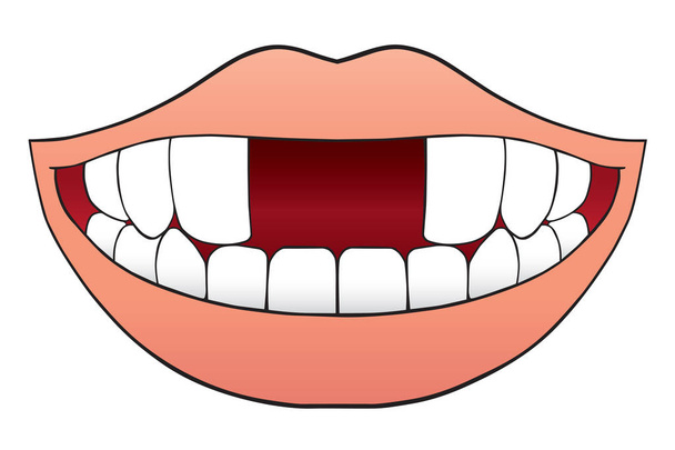 Two Front Teeth Missing - Vector, Image