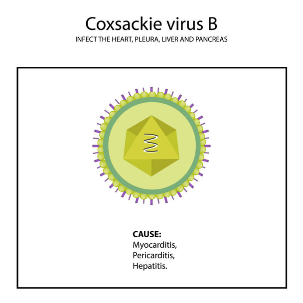 Struktura viru Coxsackie B. příznaky nemoci. Enterovirus. Infografika. Vektorové ilustrace v izolovaných pozadí - Vektor, obrázek