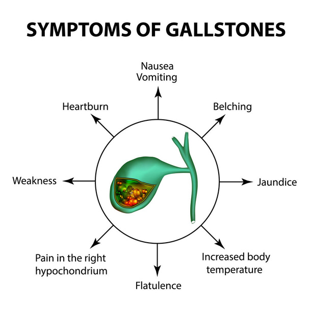 Symptome von Steinen in der Gallenblase. Infografiken. Vektor-Illustration auf isoliertem Hintergrund - Vektor, Bild