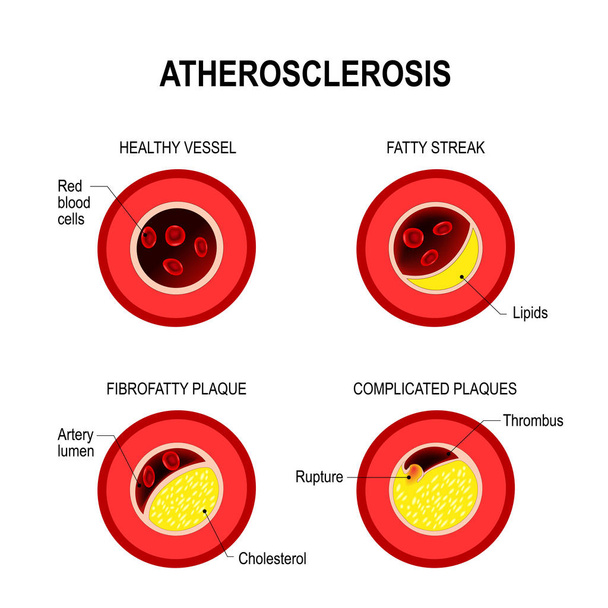 Etapas de la aterosclerosis
. - Vector, imagen