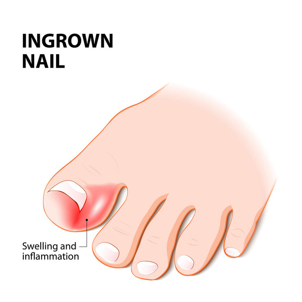 Ingrown nail. nail disease - Vector, Image