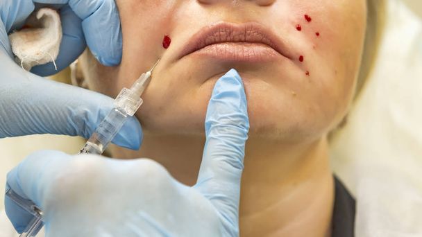 Dermatologist performs contour plastic to correction of nasolabi - Photo, Image