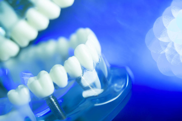 Dental alignment teeth model - Photo, Image