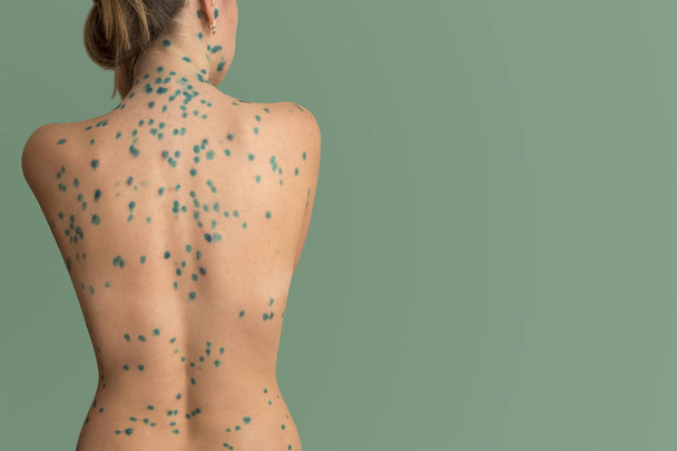 mujer espalda varicela enferma
 - Foto, imagen