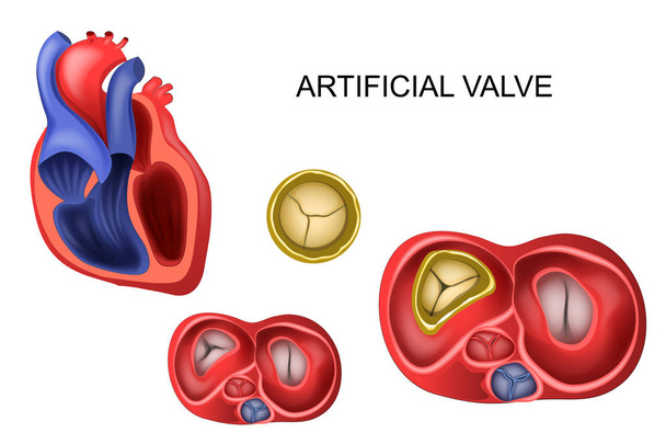 prosthetic tricuspid heart valve - Vector, Image