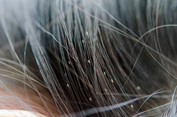 Вши на волосах
 - Фото, изображение