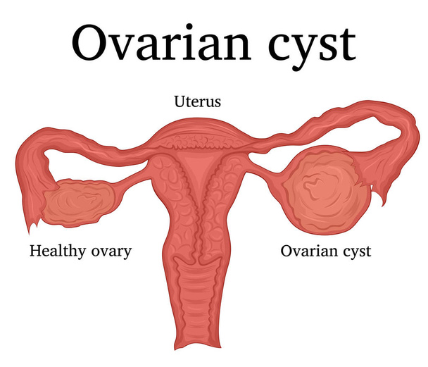Illustration of Ovarian cyst - Vector, Image