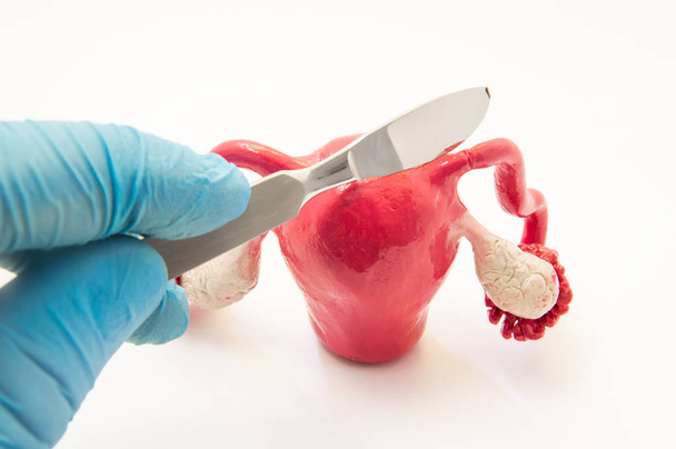 Jajowodu chirurgii leczenia niepłodności lub Ciąża pozamaciczna zdjęcie koncepcja. Ręce lekarza ze skalpelem jest powyżej modelu anatomiczne macicy, jajowodów i jajników - Zdjęcie, obraz