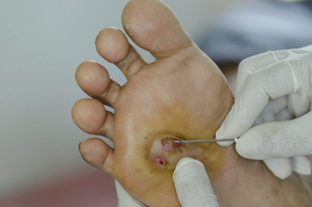 Diabetes foot wound. - Photo, Image